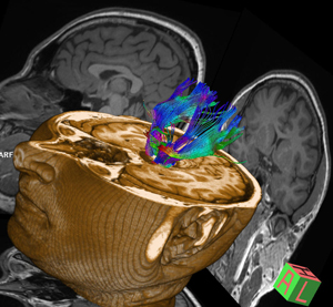 #D tractography