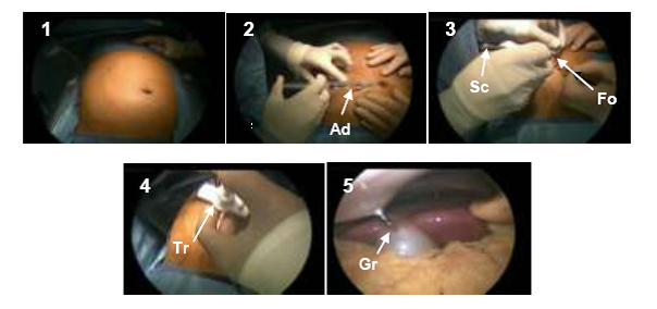 Numerical Simulation Research and Improvement of Surgical Procedures