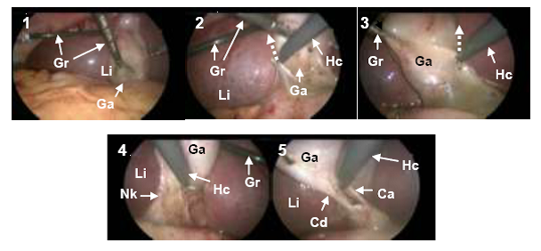 Peritoneal Preparation