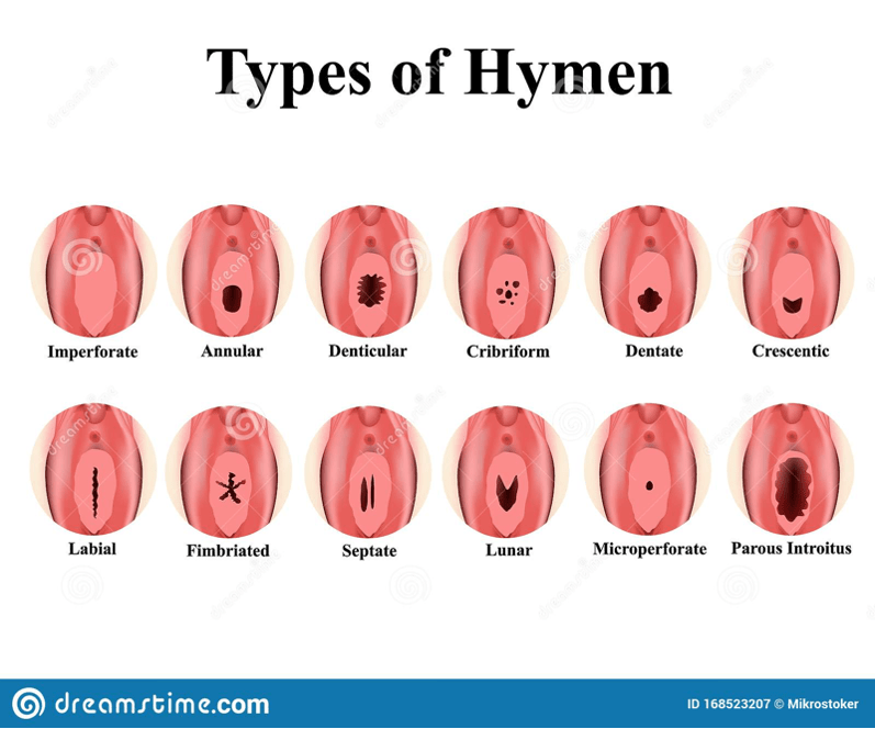 types of hymen