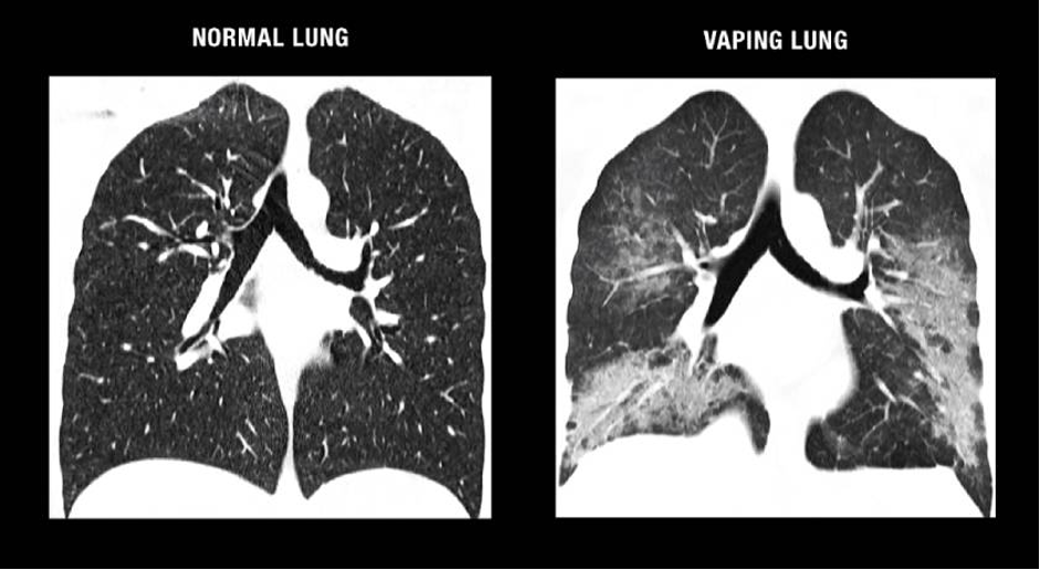 regular lungs versus vaping lungs